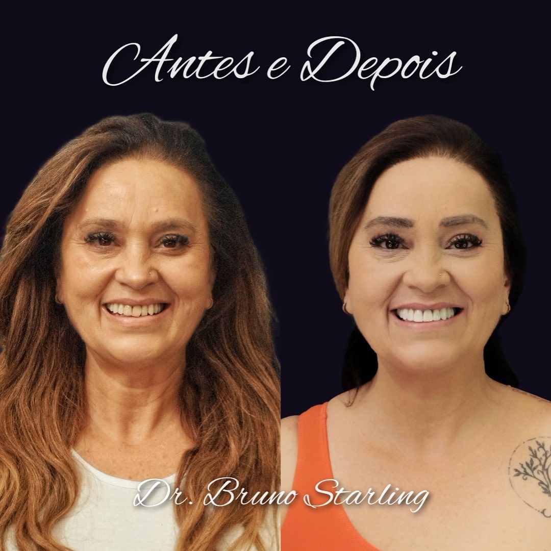 Resultado de Implante 3